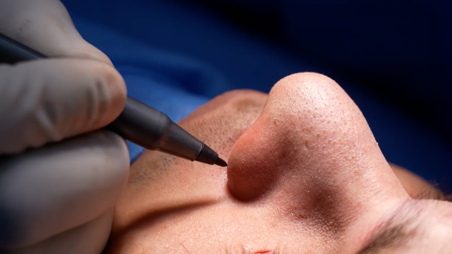 Rhinoplasty with rib grafting surgery